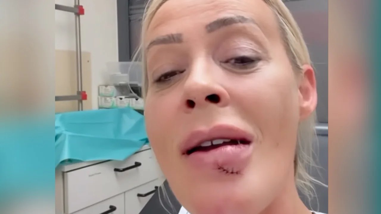 Cora Schumacher mitten in der Nacht in der Notaufnahme. Ihre Lippe muss genäht werden